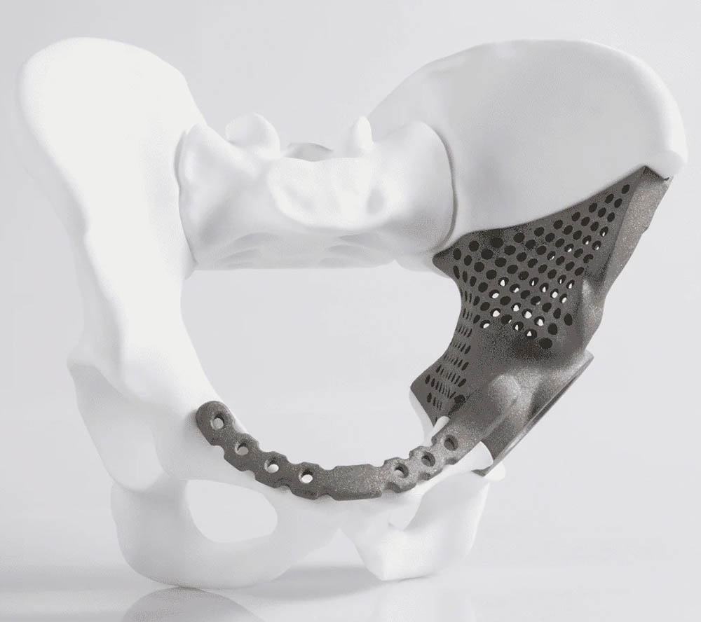 Προσαρμοσμένα ιατρικά εμφυτεύματα